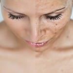 Férias, Sol, Praia e… Melasma