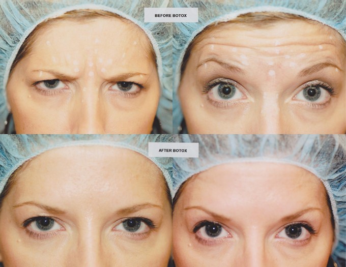 botox-antes-e-depois