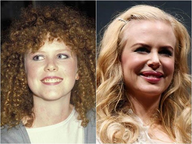 preenchimento boca nicole kidman