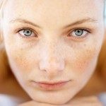 Melasma e Ácido Tranexâmico